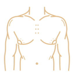 Ginecomastia